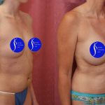 Breast Augmentation Before & After Patient #14589