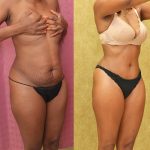 Tummy Tuck (Abdominoplasty) Small Size Before & After Patient #14590
