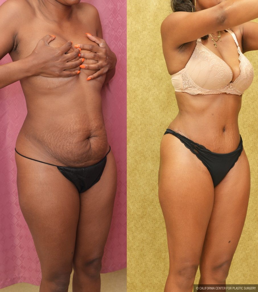 Tummy Tuck (Abdominoplasty) Small Size Before & After Patient #14590