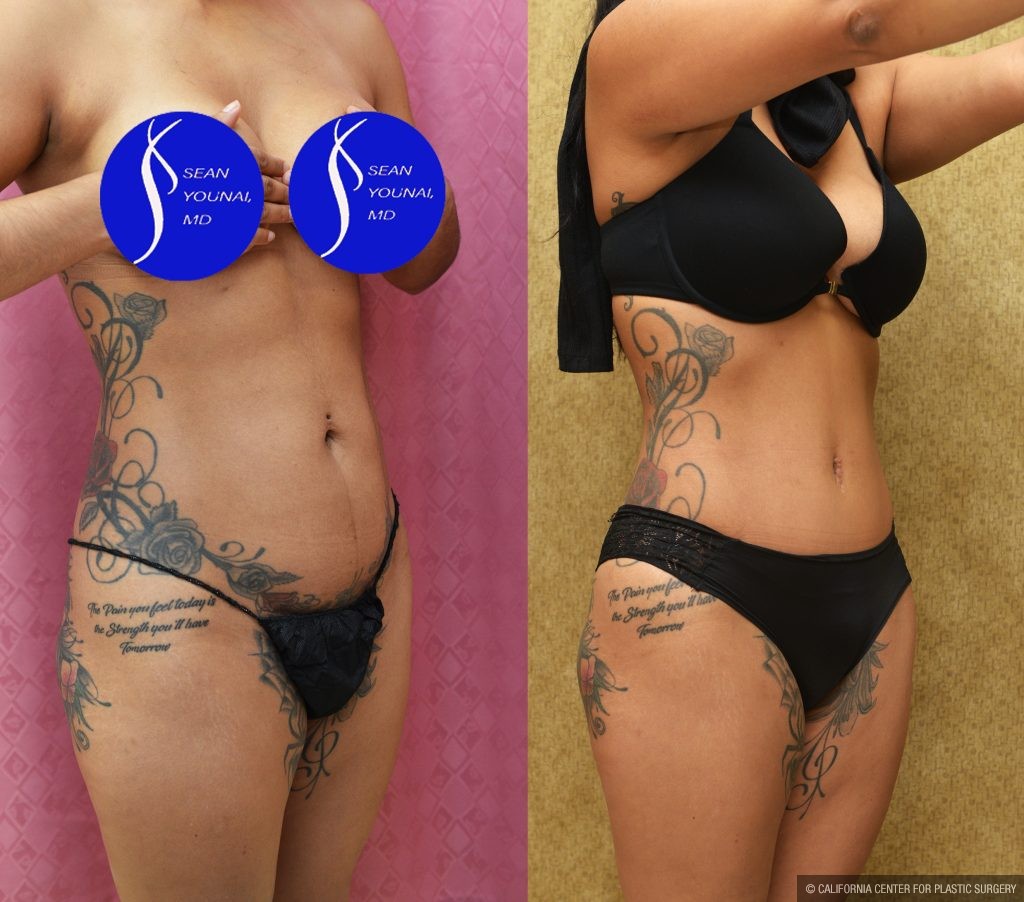Tummy Tuck (Abdominoplasty) Small Size Before & After Patient #14591