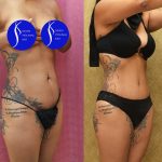 Tummy Tuck (Abdominoplasty) Small Size Before & After Patient #14591