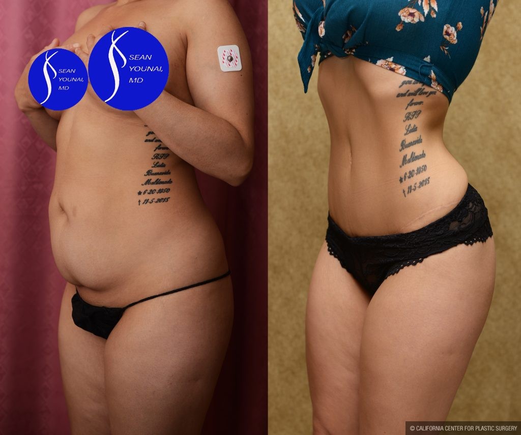 Tummy Tuck (Abdominoplasty) Small Size Before & After Patient #14592