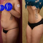 Tummy Tuck (Abdominoplasty) Small Size Before & After Patient #14592