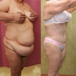 Tummy Tuck (Abdominoplasty) Super Plus Size Before & After Patient #14575