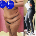 Tummy Tuck (Abdominoplasty) Plus Size Before & After Patient #14576