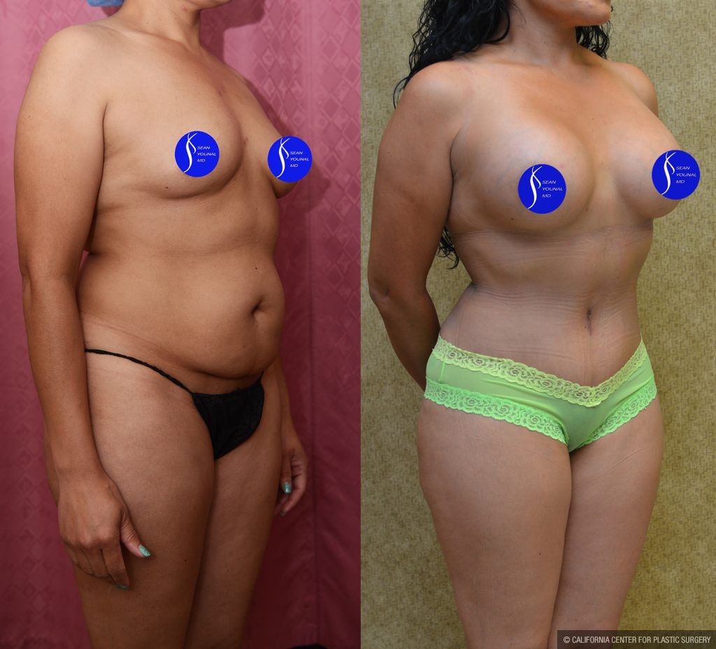 Mommy Makeover Before & After Patient #14593