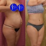 Tummy Tuck (Abdominoplasty) Small Size Before & After Patient #14579