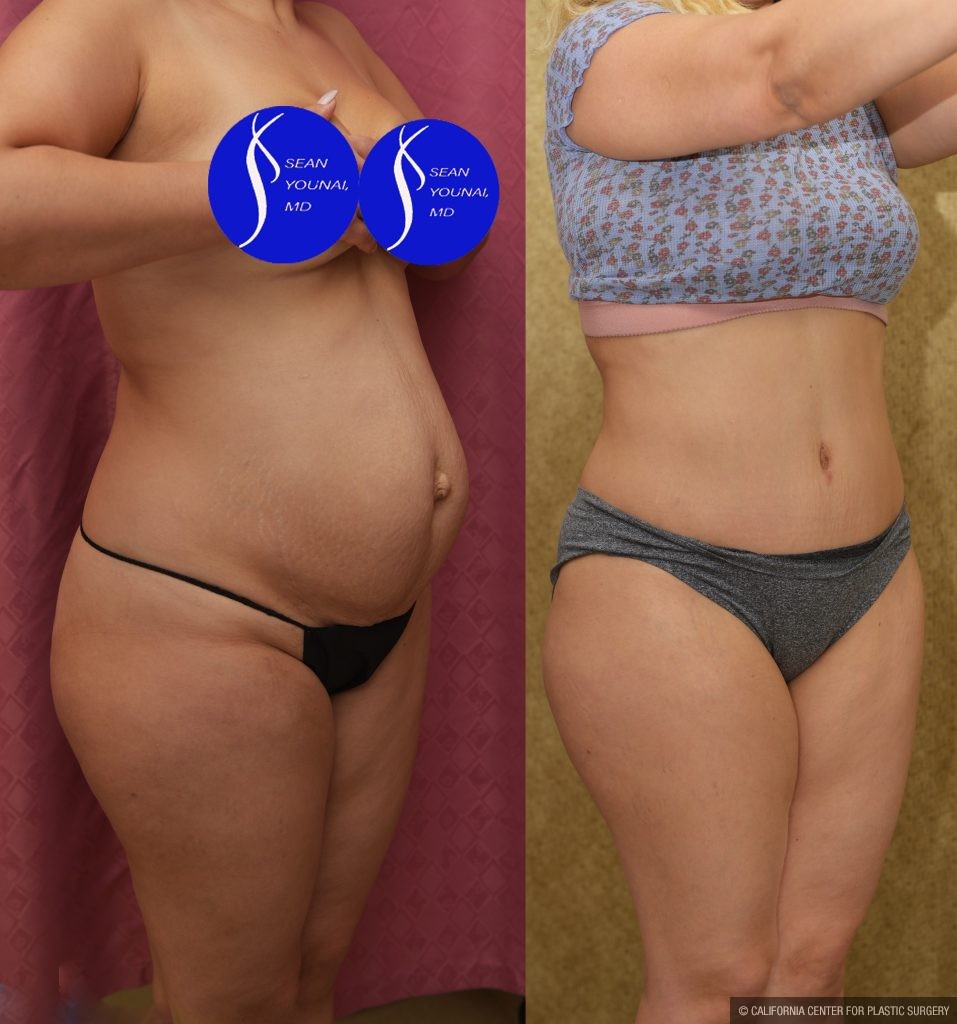 Tummy Tuck (Abdominoplasty) Small Size Before & After Patient #14579