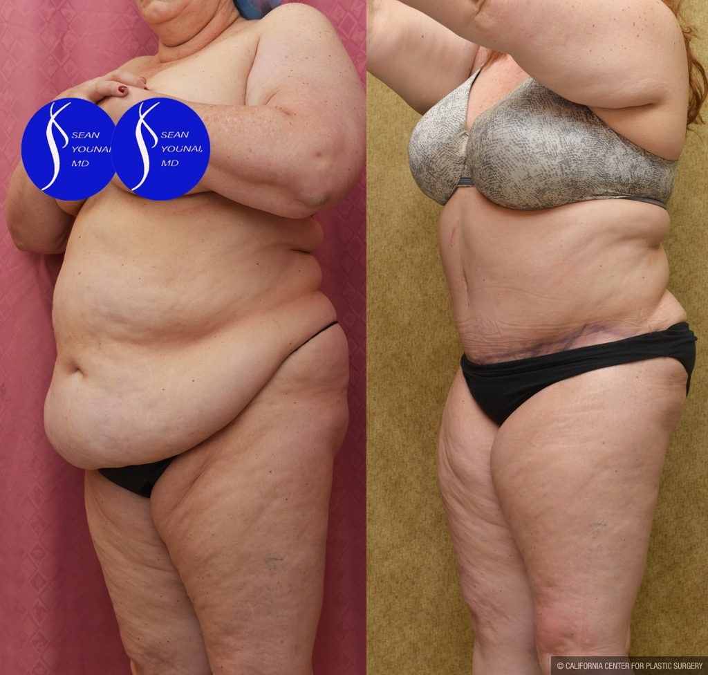 Tummy Tuck (Abdominoplasty) Plus Size Before & After Patient #14580