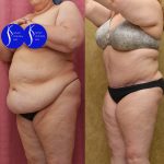 Tummy Tuck (Abdominoplasty) Plus Size Before & After Patient #14580