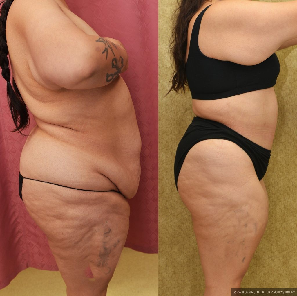 Tummy Tuck (Abdominoplasty) Plus Size Before & After Patient #14582