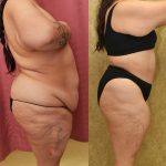 Tummy Tuck (Abdominoplasty) Plus Size Before & After Patient #14582
