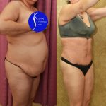 Tummy Tuck (Abdominoplasty) Medium Size Before & After Patient #14583