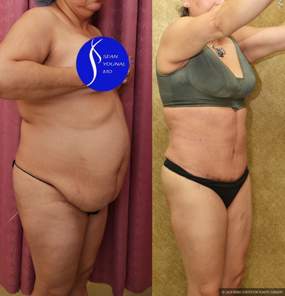 Tummy Tuck (Abdominoplasty) Medium Size Before & After Patient #14583