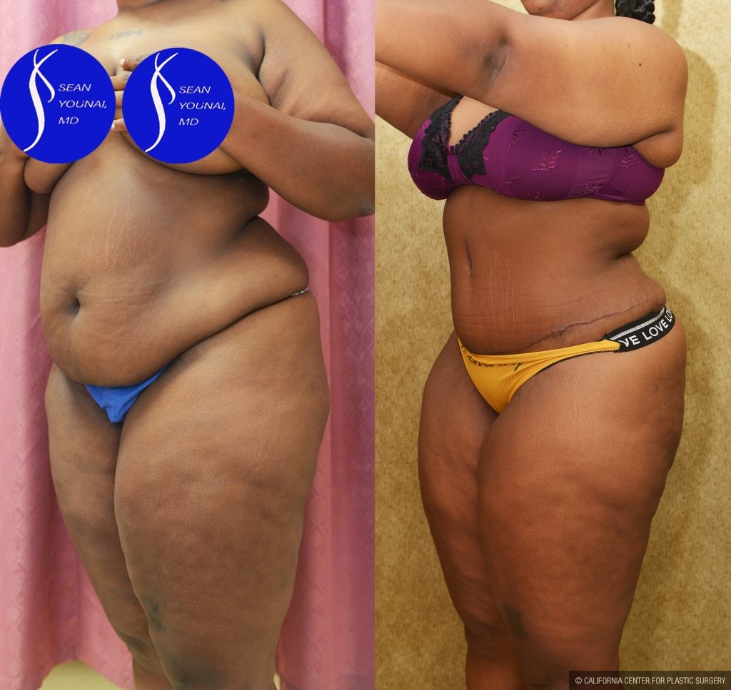 African American Tummy Tuck (Abdominoplasty) Before & After Patient #14585