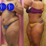 African American Tummy Tuck (Abdominoplasty) Before & After Patient #14585