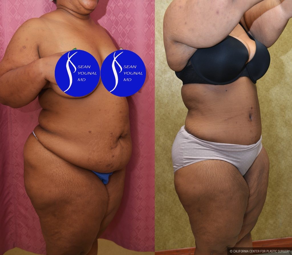 Tummy Tuck (Abdominoplasty) Plus Size Before & After Patient #14584