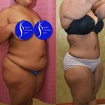 Tummy Tuck (Abdominoplasty) Plus Size Before & After Patient #14584
