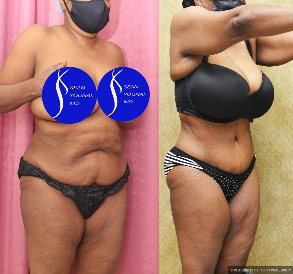 African American Tummy Tuck (Abdominoplasty) Before & After Patient #14586