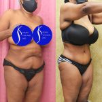 African American Tummy Tuck (Abdominoplasty) Before & After Patient #14586