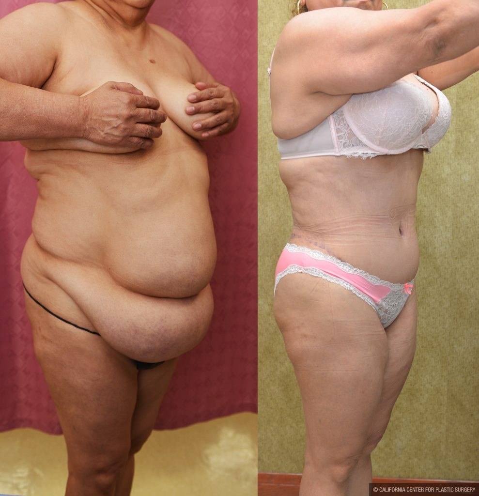 Tummy Tuck (Abdominoplasty) Super Plus Size Before & After Patient #14575
