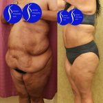 Tummy Tuck (Abdominoplasty) Super Plus Size Before & After Patient #14577