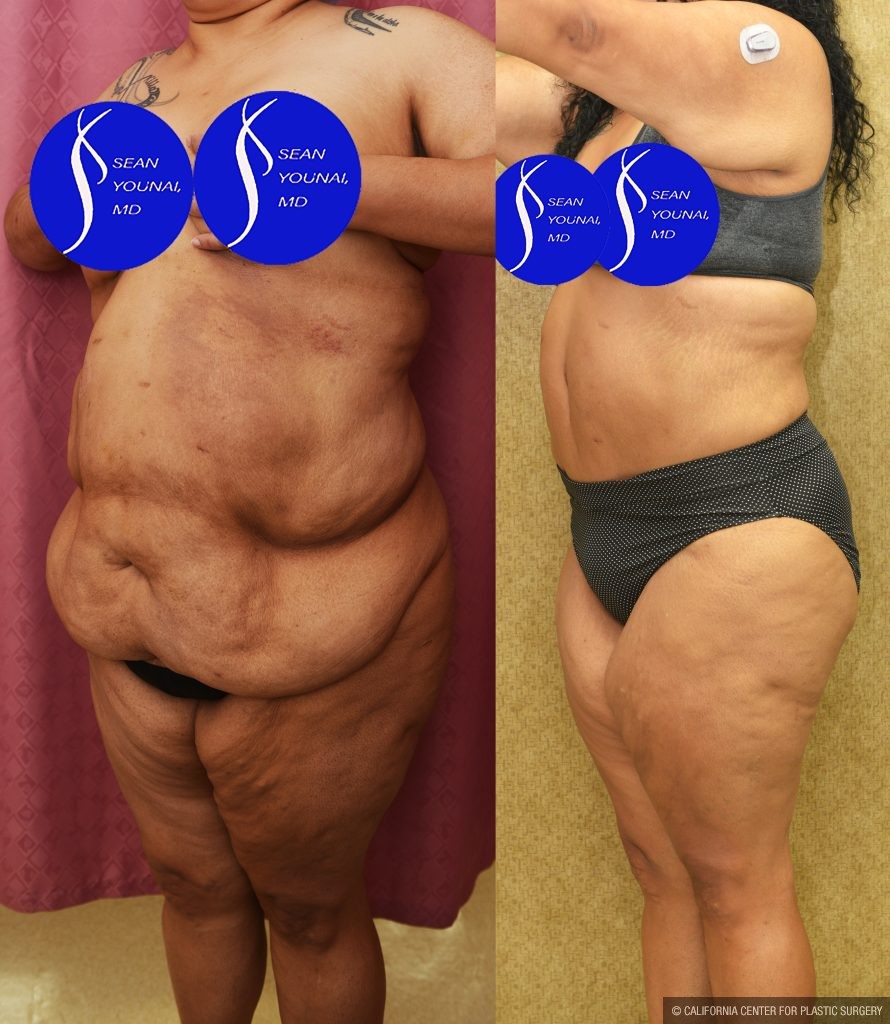 Tummy Tuck (Abdominoplasty) Super Plus Size Before & After Patient #14577