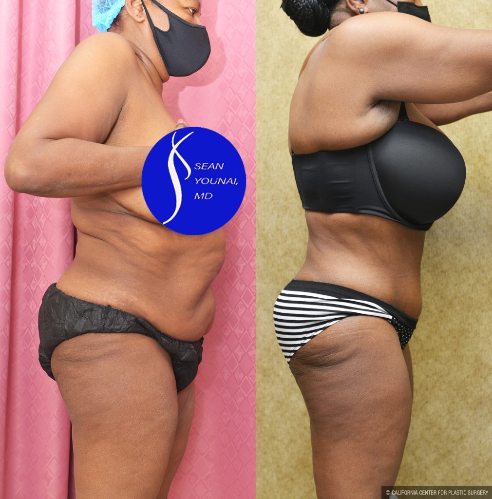 African American Tummy Tuck (Abdominoplasty) Before & After Patient #14586