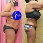 African American Tummy Tuck (Abdominoplasty) Before & After Patient #14586