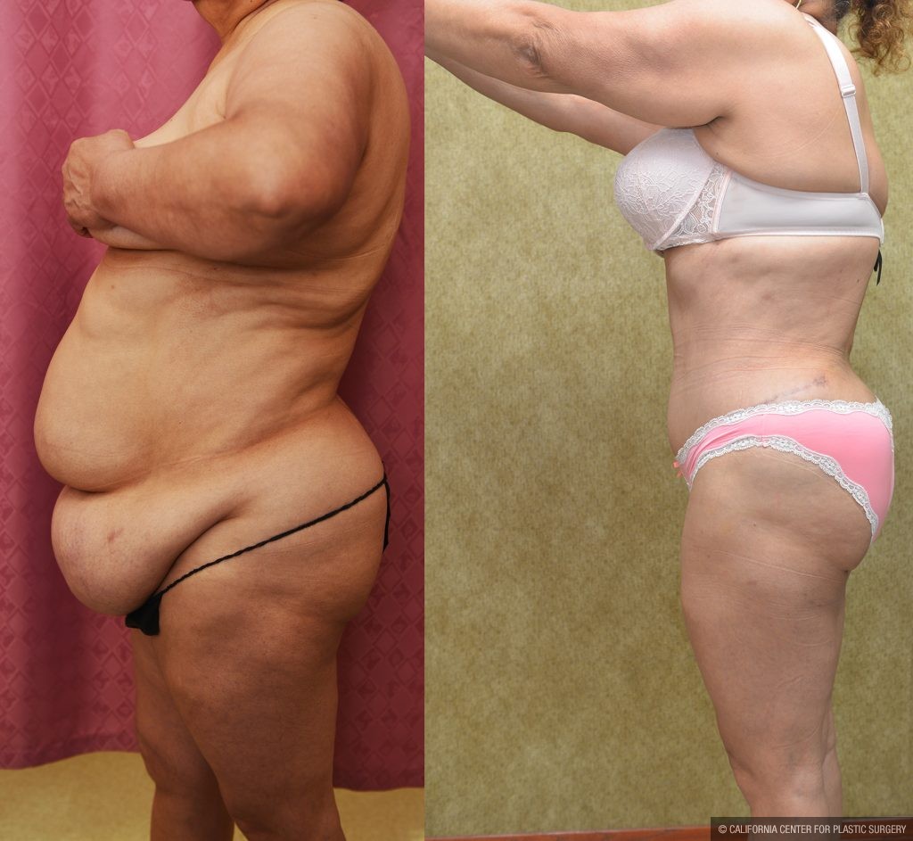 Tummy Tuck (Abdominoplasty) Super Plus Size Before & After Patient #14575