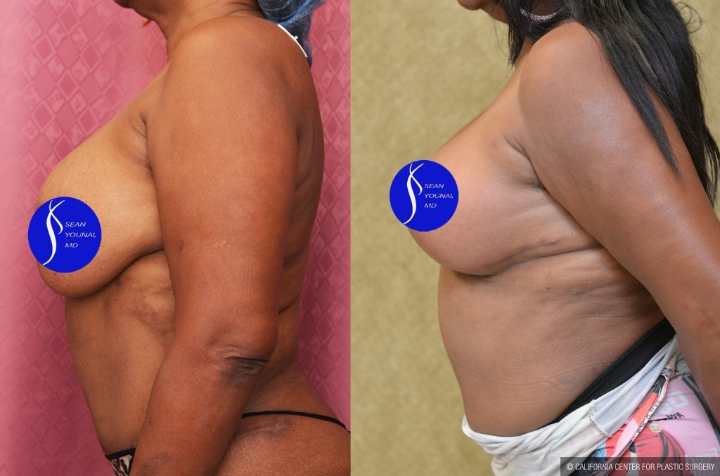 Breast Lift - Full Before & After Patient #14588
