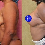 Breast Lift - Full Before & After Patient #14588