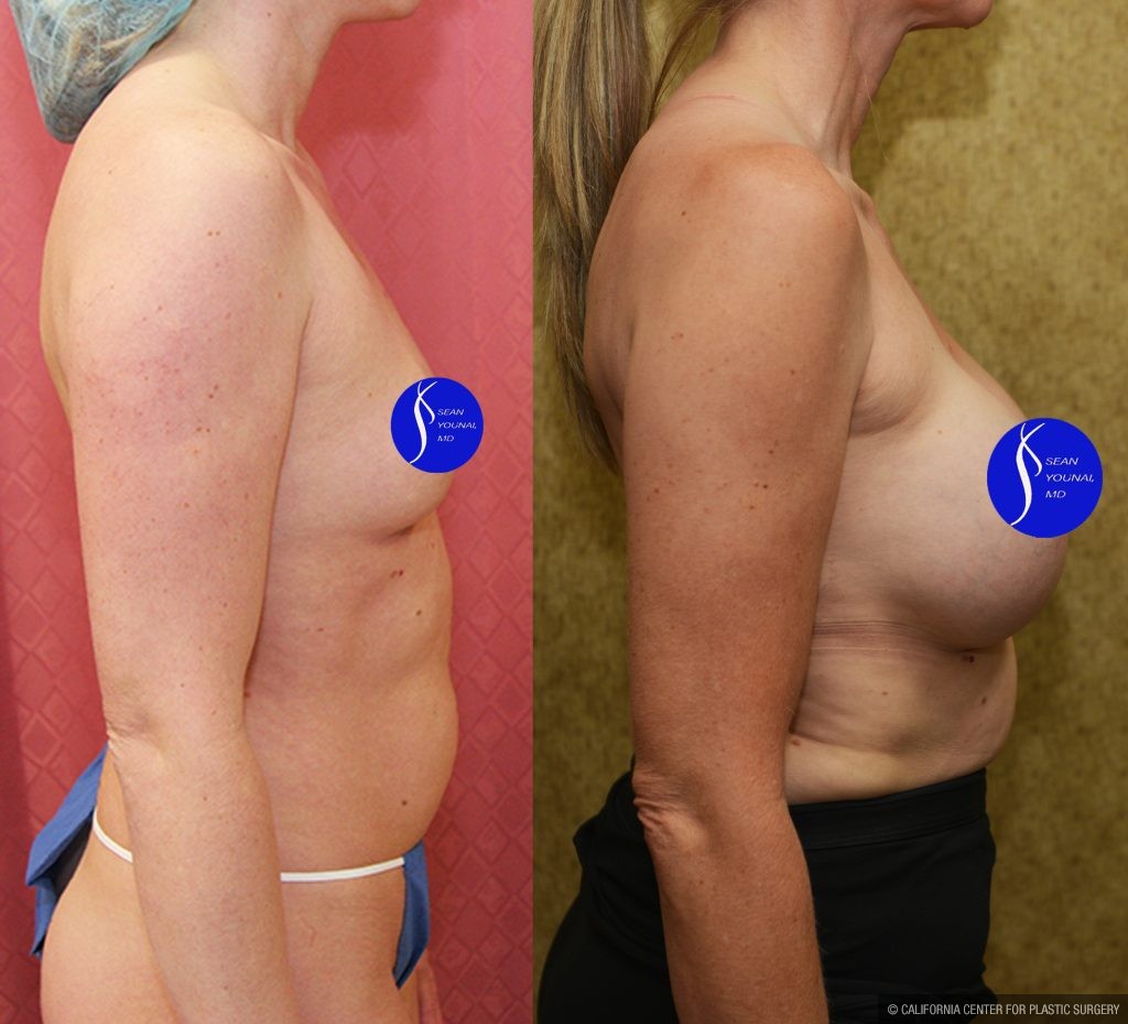 Breast Augmentation Before & After Patient #14589