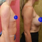 Breast Augmentation Before & After Patient #14589