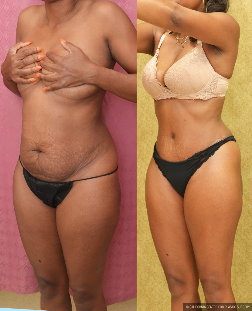 Tummy Tuck (Abdominoplasty) Small Size Before & After Patient #14590