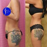 Tummy Tuck (Abdominoplasty) Small Size Before & After Patient #14591