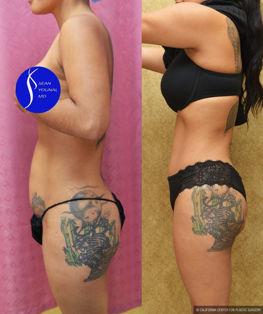 Tummy Tuck (Abdominoplasty) Small Size Before & After Patient #14591