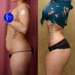 Tummy Tuck (Abdominoplasty) Small Size Before & After Patient #14592