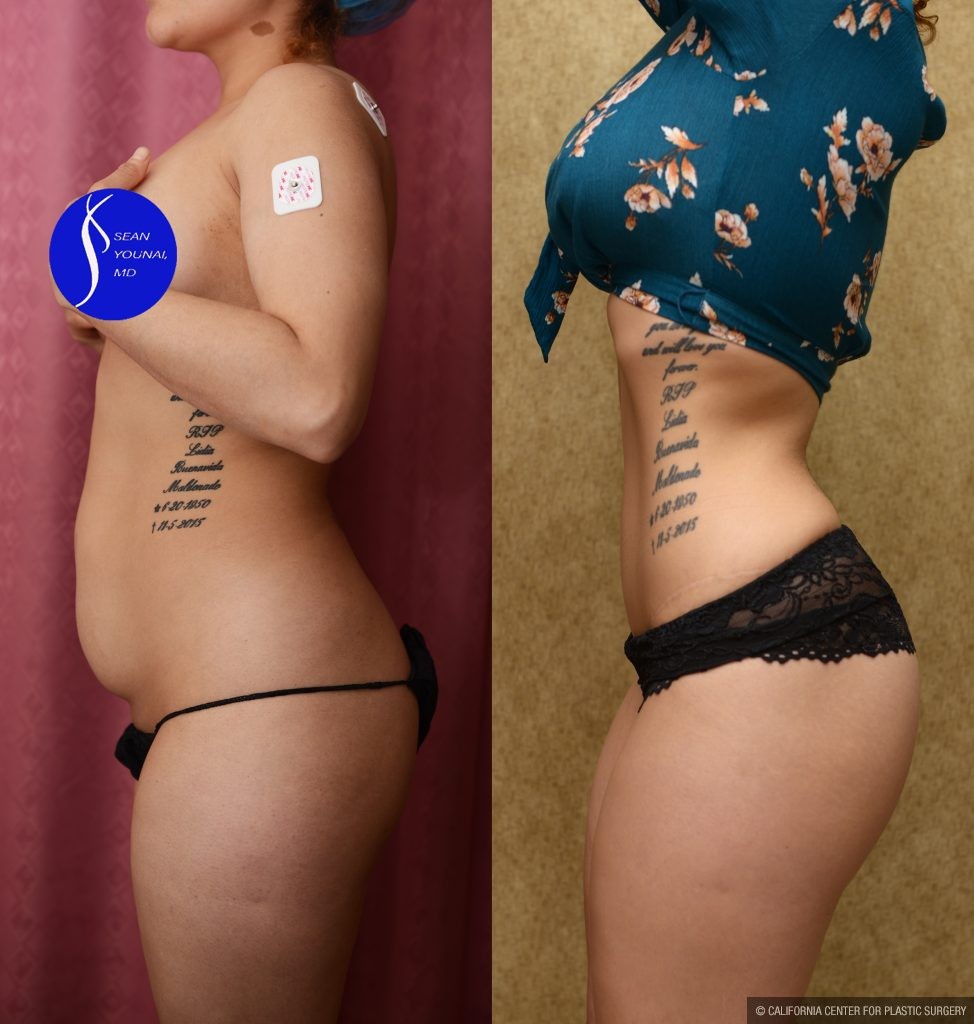 Tummy Tuck (Abdominoplasty) Small Size Before & After Patient #14592
