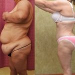 Tummy Tuck (Abdominoplasty) Super Plus Size Before & After Patient #14575