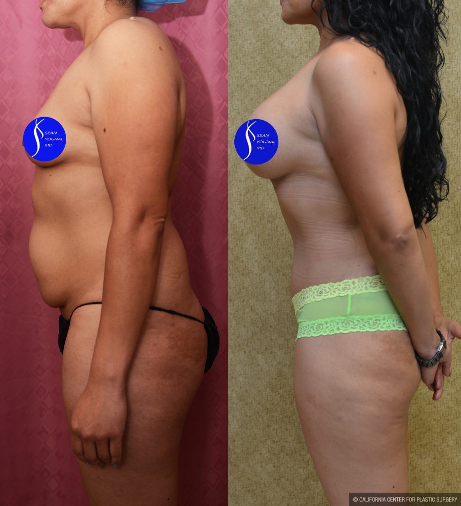 Mommy Makeover Before & After Patient #14593