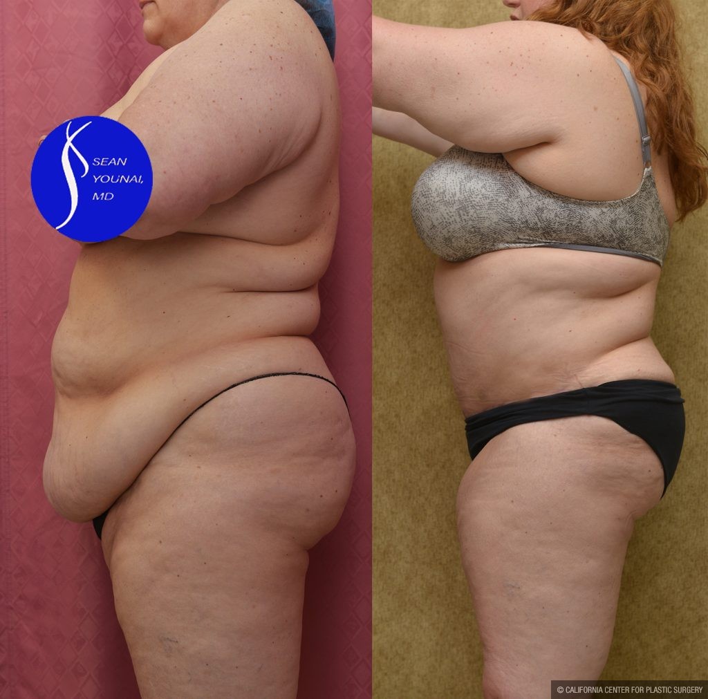 Tummy Tuck (Abdominoplasty) Plus Size Before & After Patient #14580
