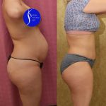 Tummy Tuck (Abdominoplasty) Small Size Before & After Patient #14579
