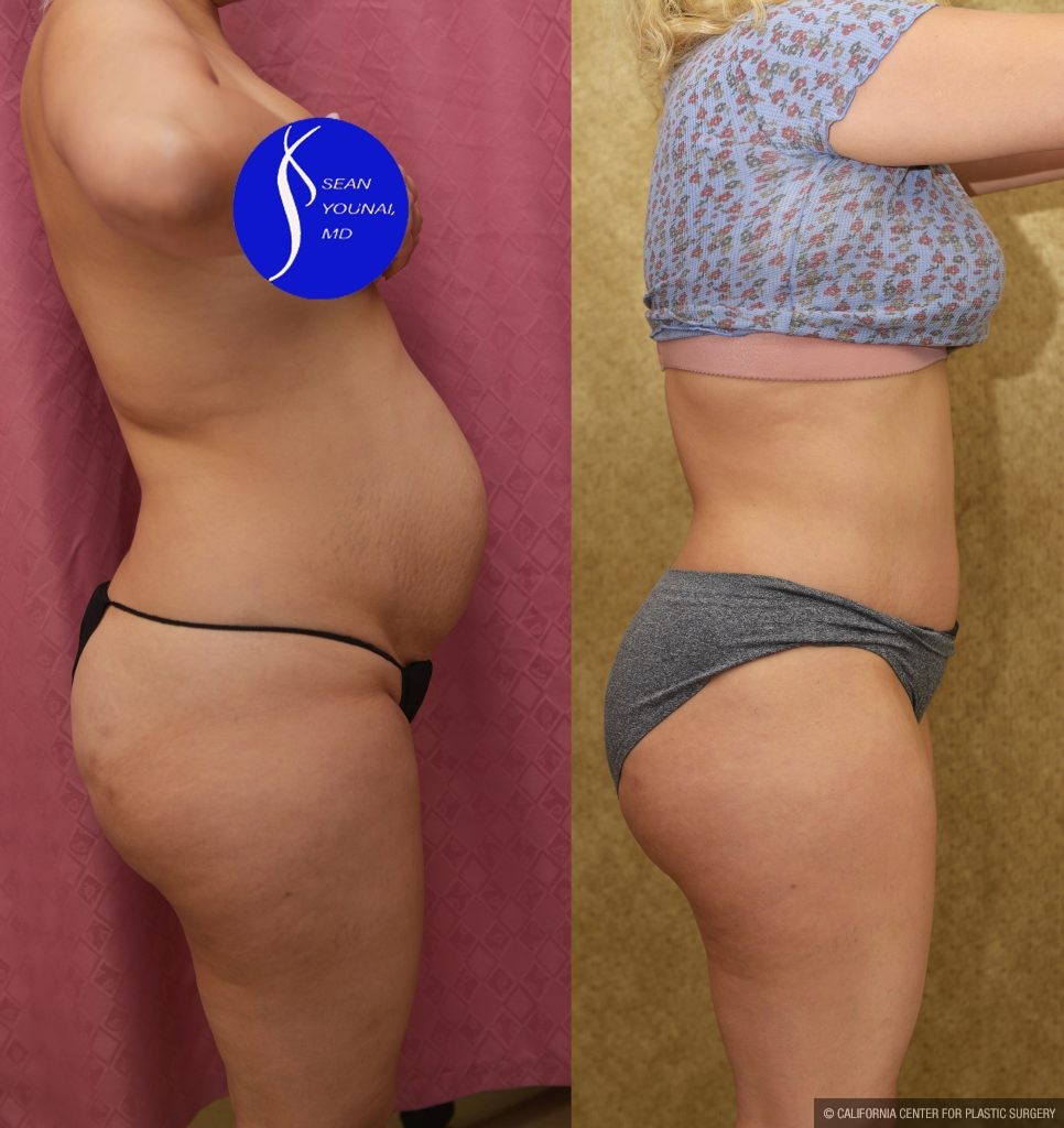 Tummy Tuck (Abdominoplasty) Small Size Before & After Patient #14579