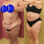Tummy Tuck (Abdominoplasty) Plus Size Before & After Patient #14582