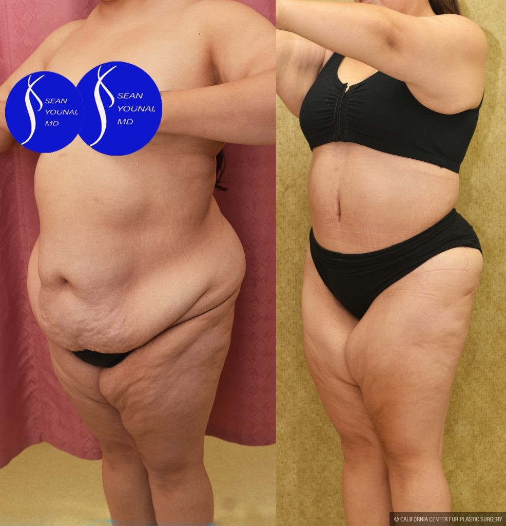 Tummy Tuck (Abdominoplasty) Plus Size Before & After Patient #14582
