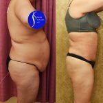 Tummy Tuck (Abdominoplasty) Medium Size Before & After Patient #14583