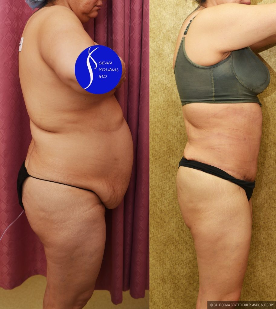 Tummy Tuck (Abdominoplasty) Medium Size Before & After Patient #14583