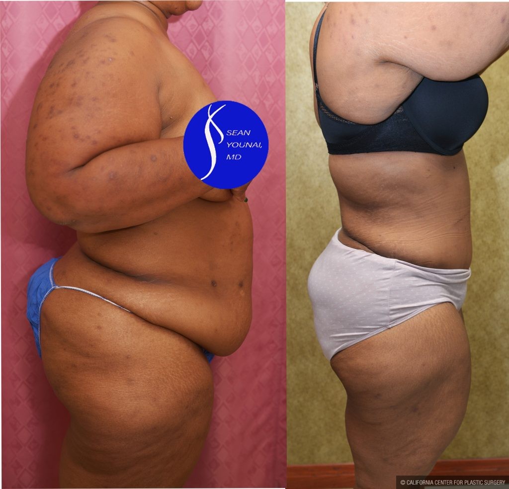 Tummy Tuck (Abdominoplasty) Plus Size Before & After Patient #14584