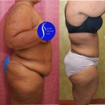 Tummy Tuck (Abdominoplasty) Plus Size Before & After Patient #14584